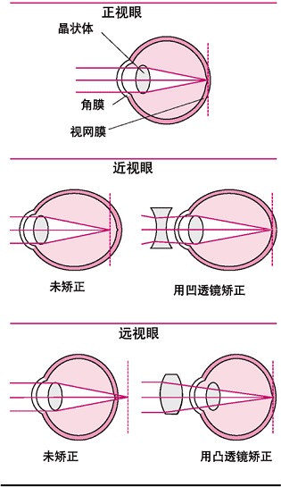 屈光不正治疗方法