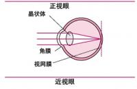 治疗屈光不正最有效的方法都有那些