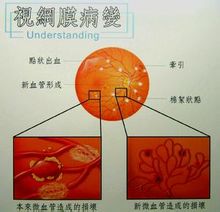 视网膜病变