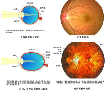 为什么会有高度近视